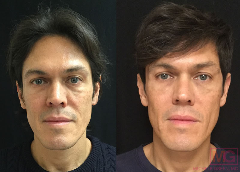 47 MA male before after sculptra FRONT
