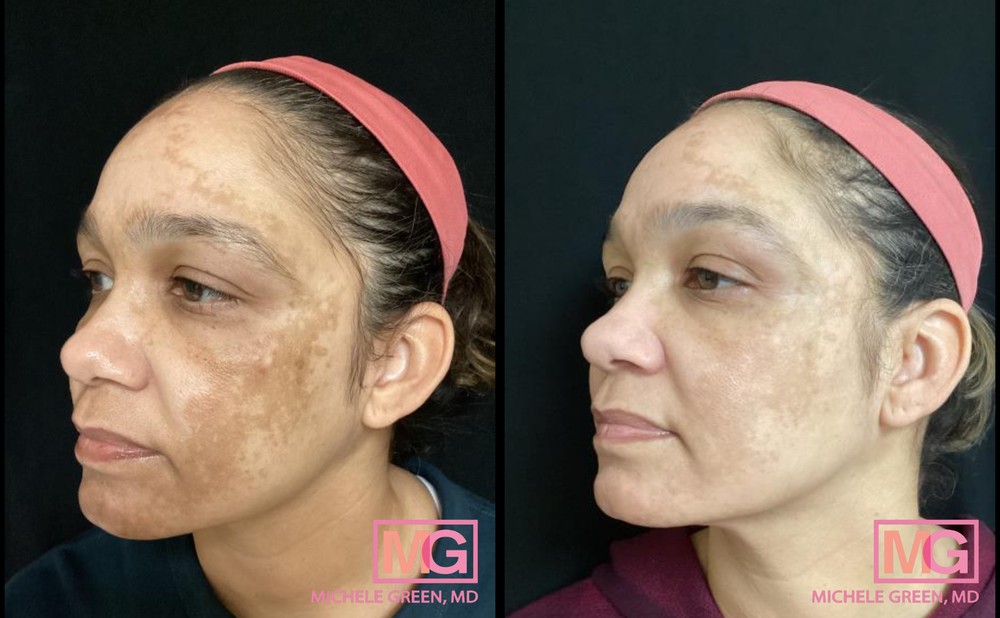 48 Year Old Female Before and After 1 Month Following Cosmelan Treatment