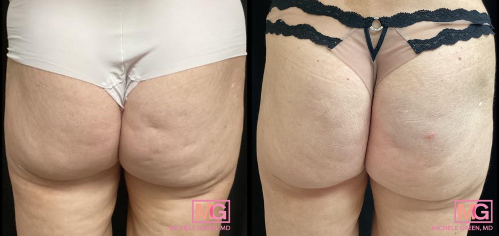 54 Year Old Female Before and After 1 Treatment of Sculptra