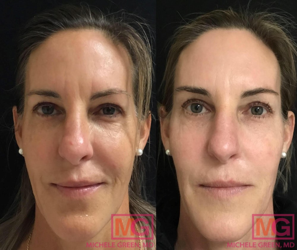 Fraxel, Botox & Alex Trivantage before and after