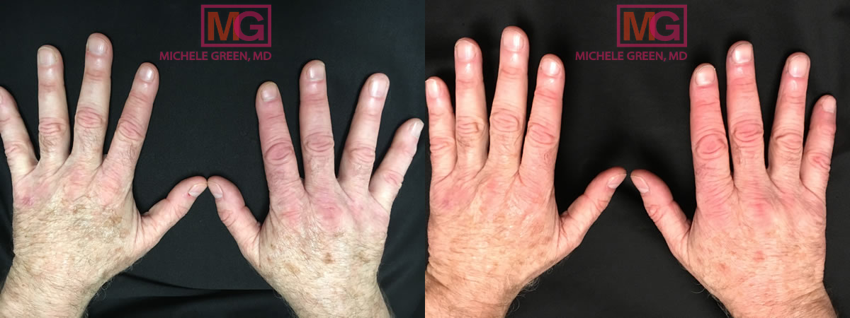 57 year old male treated for sun spots with AlexTrivantage laser