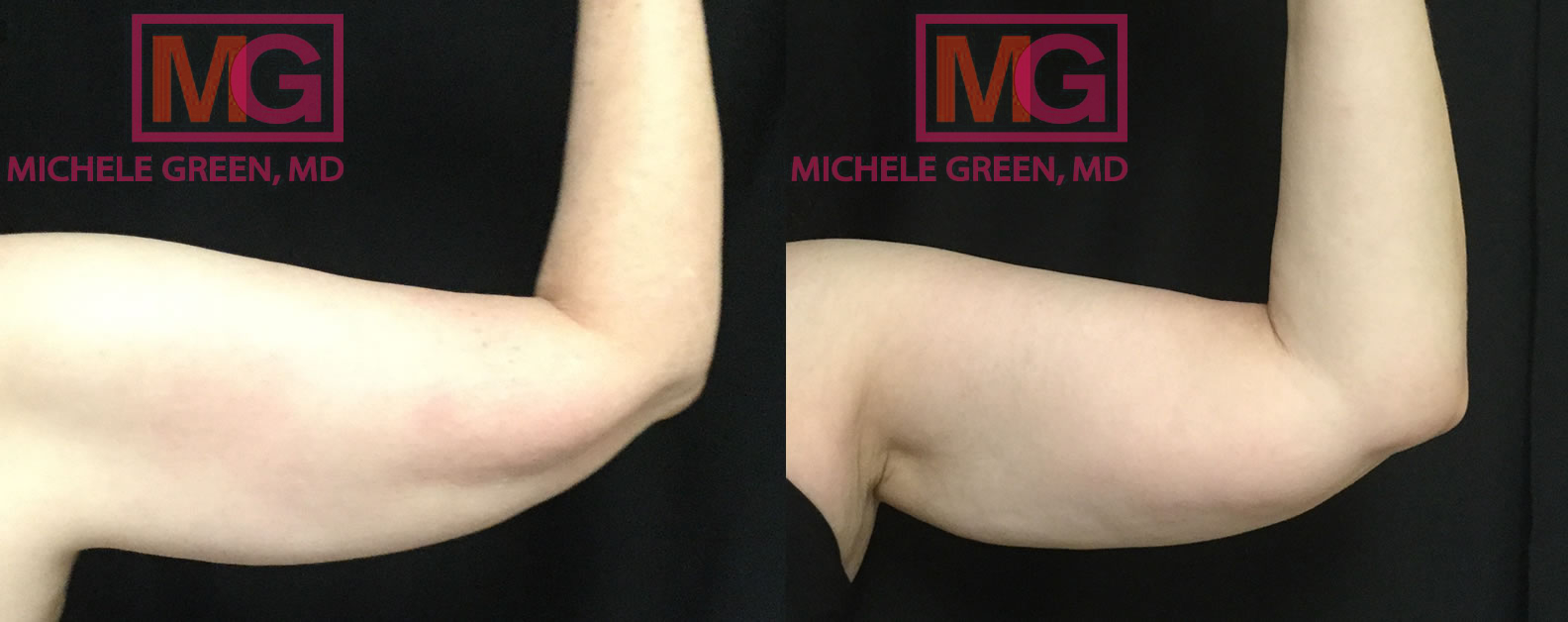 58yo female coolsculpting before after arms1 MGwatermark
