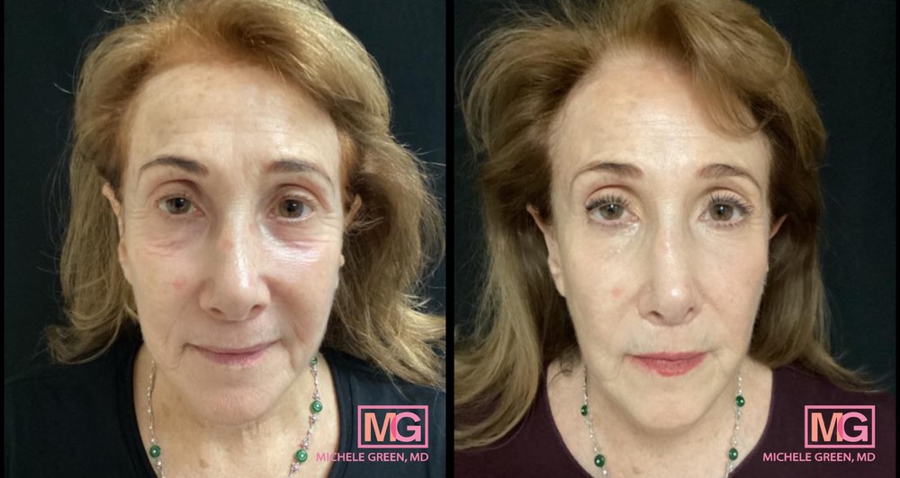 73 Year Old Female Before and After 1 Fraxel Session