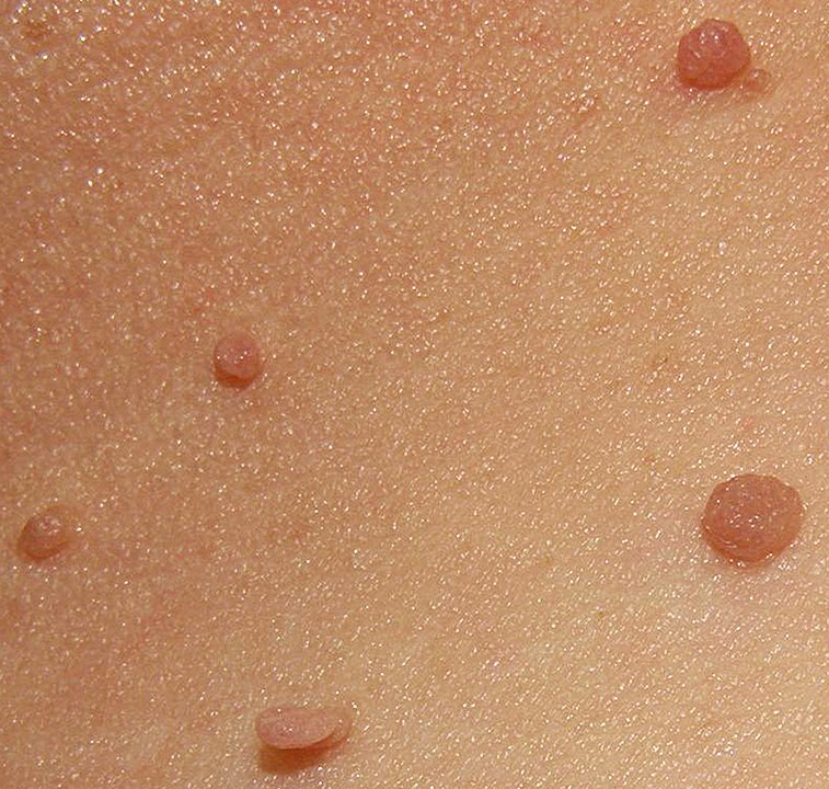 Skin Tags and Sebaceous Cyst Removal