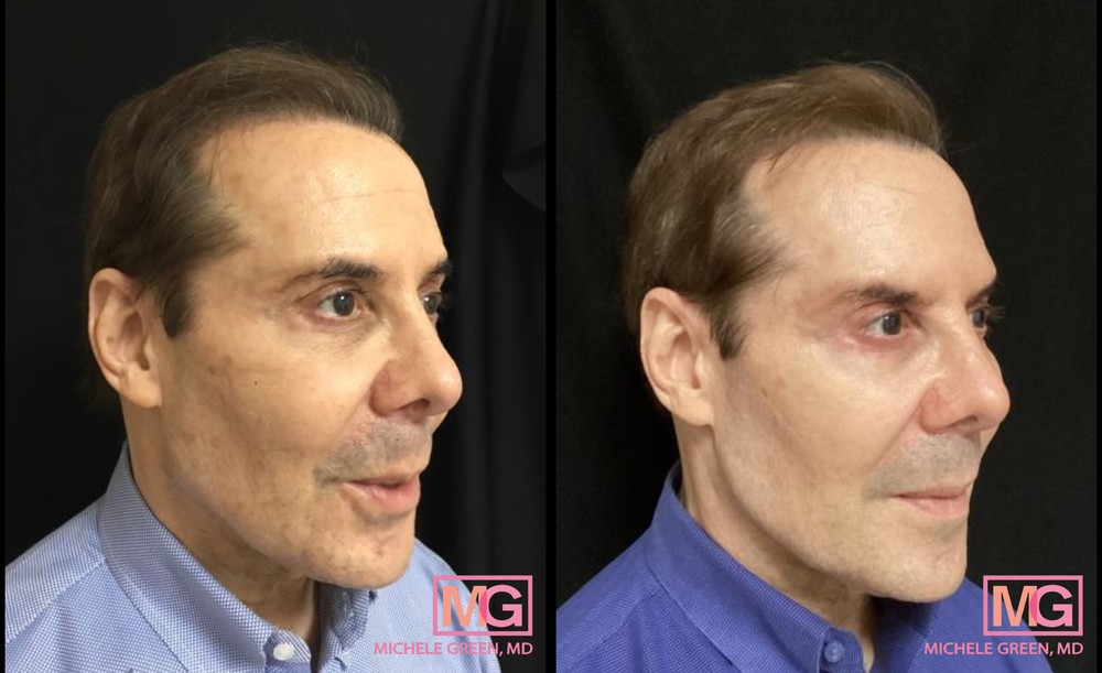 76 Year Old Male Before and After Fraxel