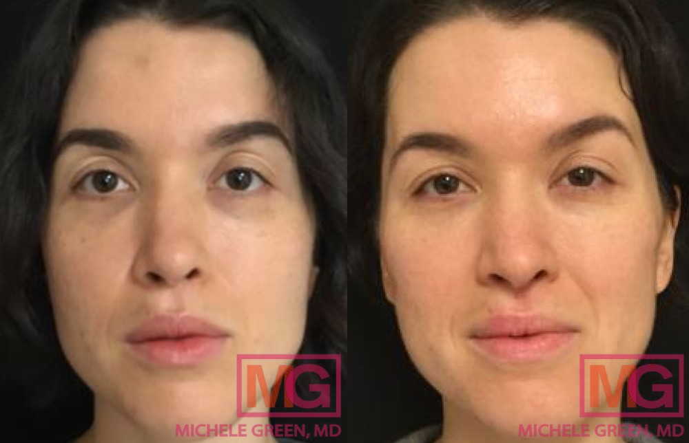 A.F. 33 yr old female Restylane undereye treatment MGWatermark