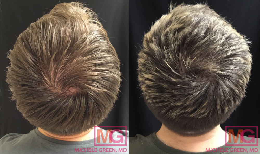 Male with PRP treatment on hair – 6 months