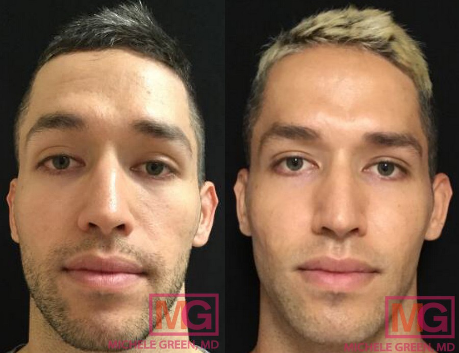 32 year old, Sculptra 5 sessions, 8 months