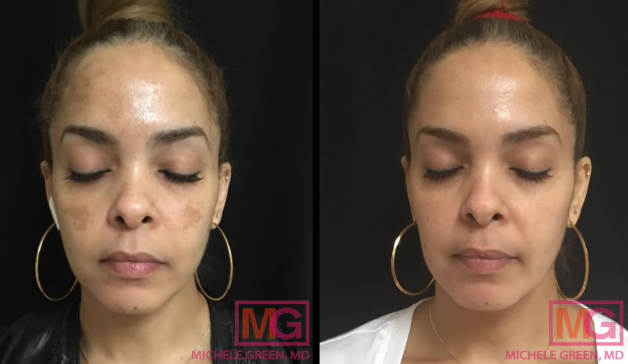 Fight Sunspots and Melasma with a Chemical Peel - Dontage