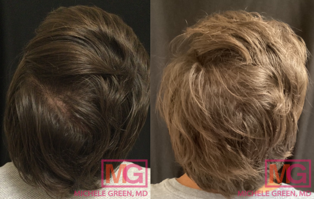 AD 33 yr old male before after PRP hair injections MGWatermark