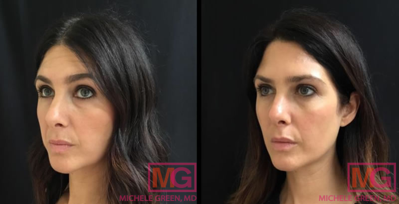 35-44 Year old woman – Botox to glabella & forehead lines