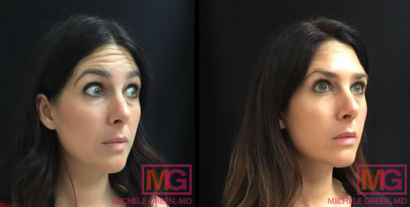 35-44 Year old woman – Botox to glabella & forehead lines