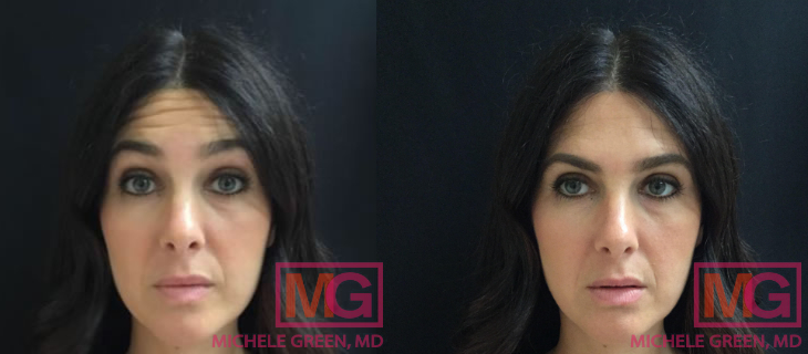 AE botox forehead glabella FRONT3 MGWatermark
