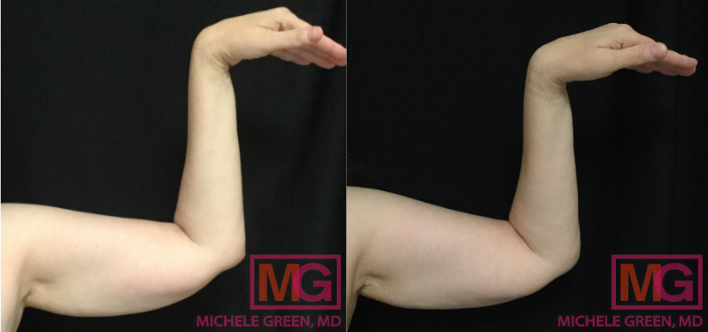 AH 61 4 month Before and After Coolsculpting CoolFit LT Inner Arm MGWatermark 1