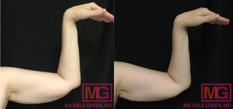 How To Get Rid Of Fat Arms & Fix Flabby Arms? — Unimeal