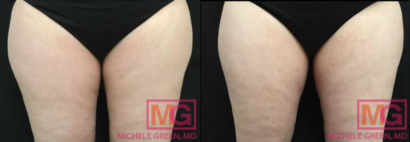 Female CoolSculpting treatment on inner thighs