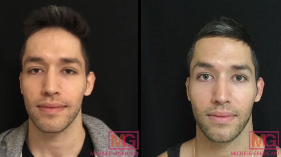 25-34 year old male, 3 Vials of Sculptra, 2 Syringes of Restylane
