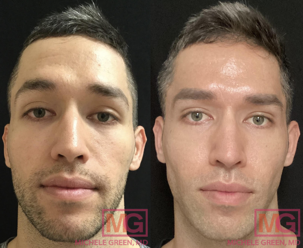AK 33 yo male before and after Sculptra FRONT 1 MGWatermark