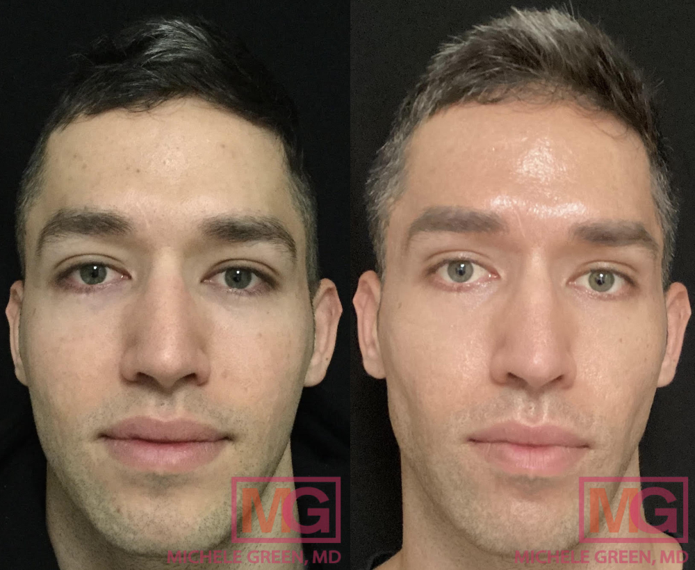 33 year old male, Sculptra before and after