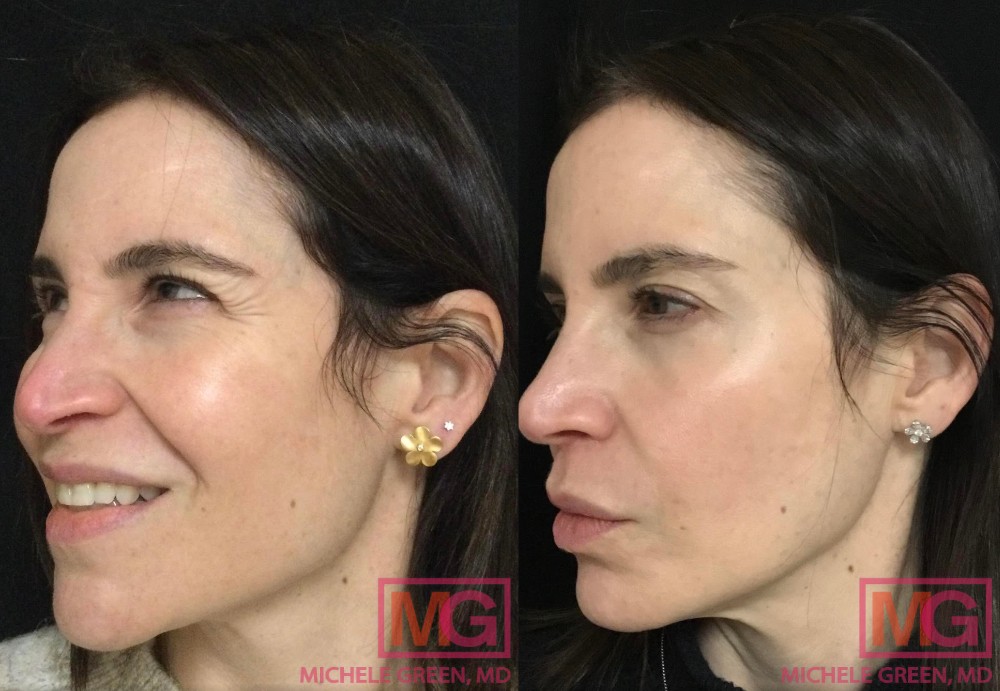 Female before and after, Botox in Glabella area