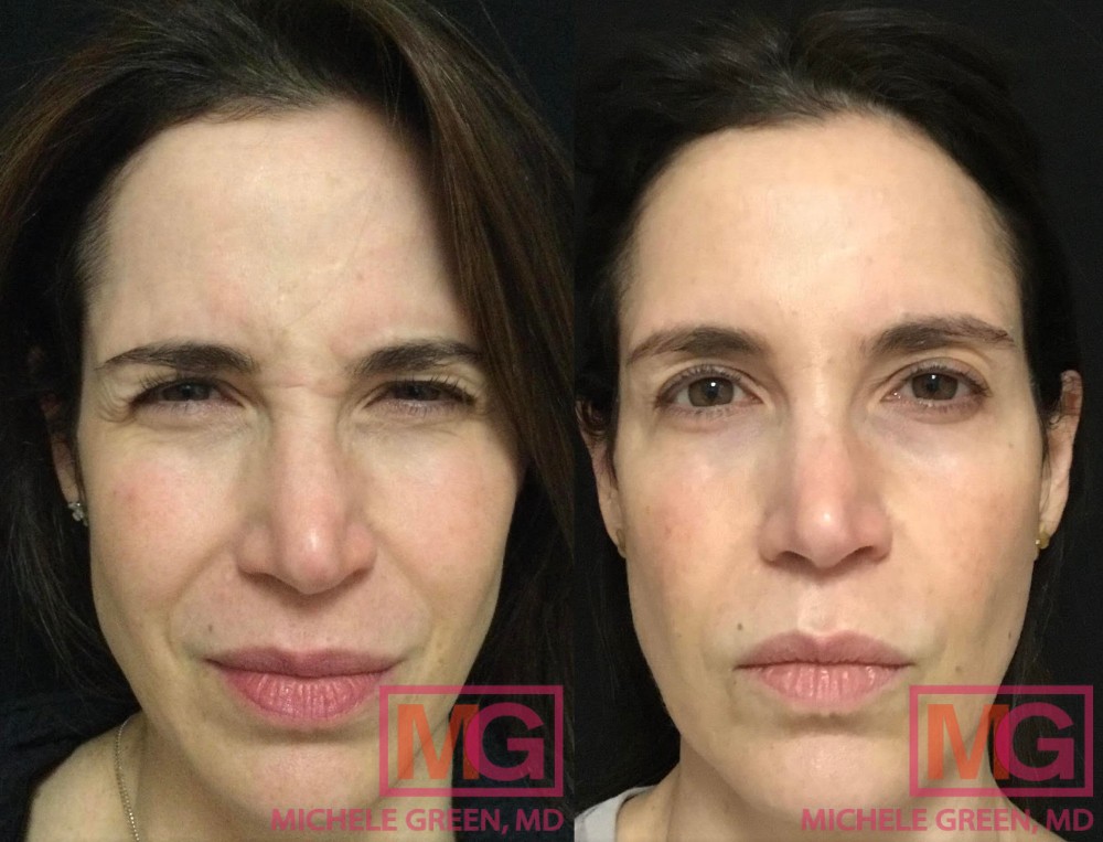 26 year old female before and after 6 months, Botox Masseter