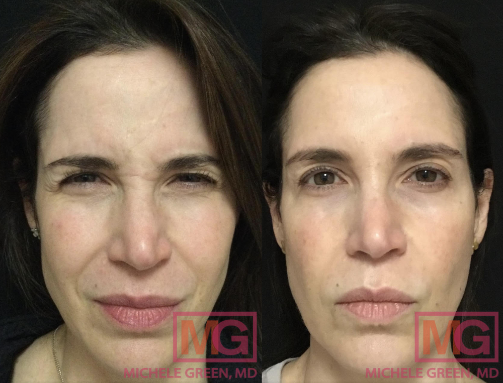 30 y/o female before and after one Botox masseter treatment 