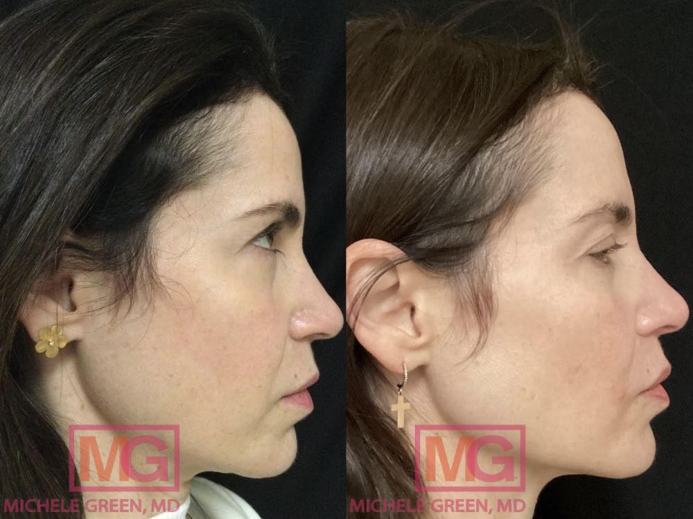 49 year old female before and after Thermage