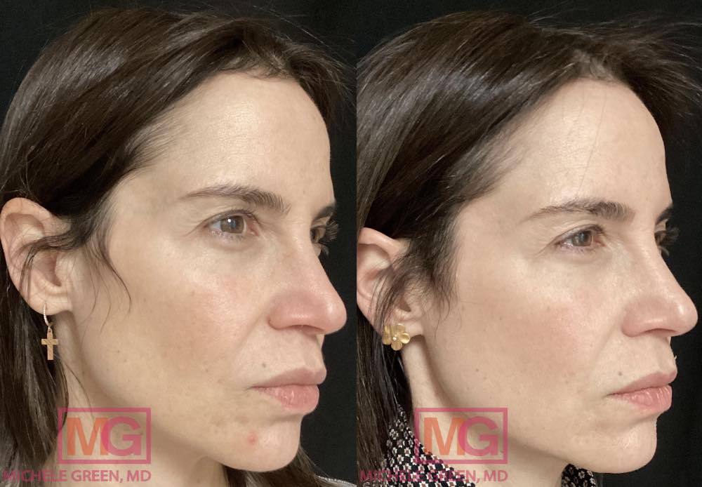 Female treated with Chemical peels before and after