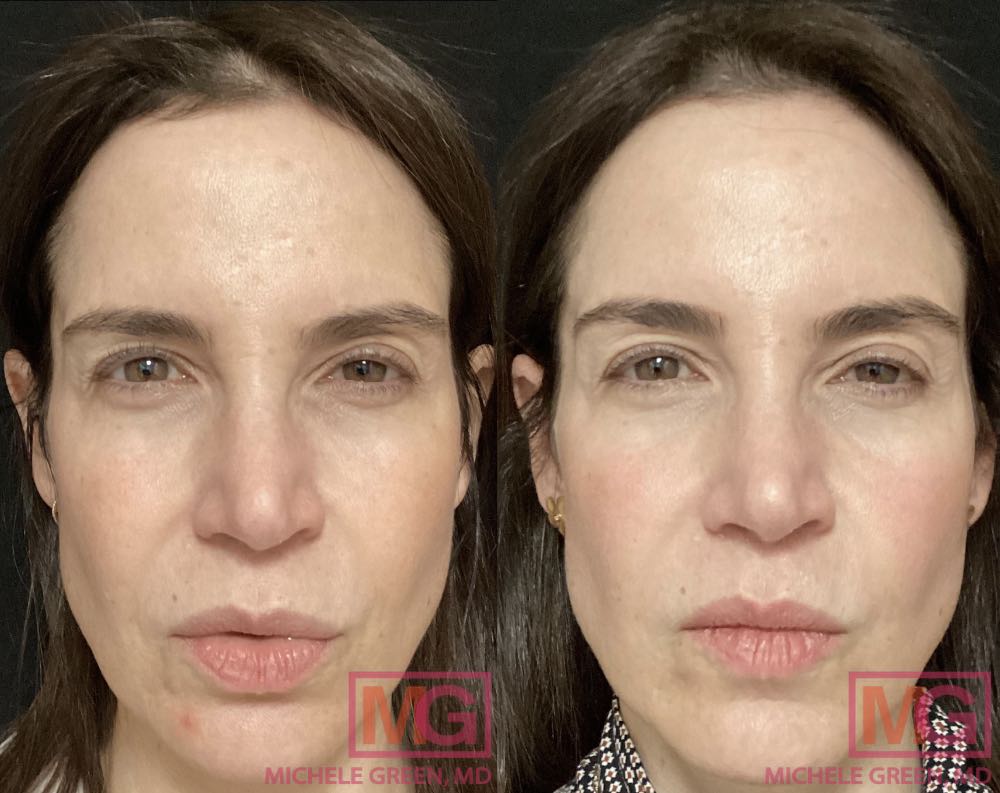 Female treated with Chemical peels before and after