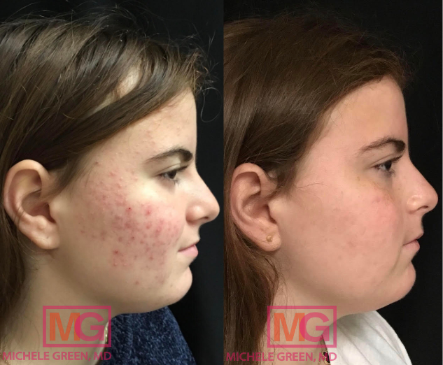 AM 16yo female 5 months before and after Accutane PROFILE R MGWatermark