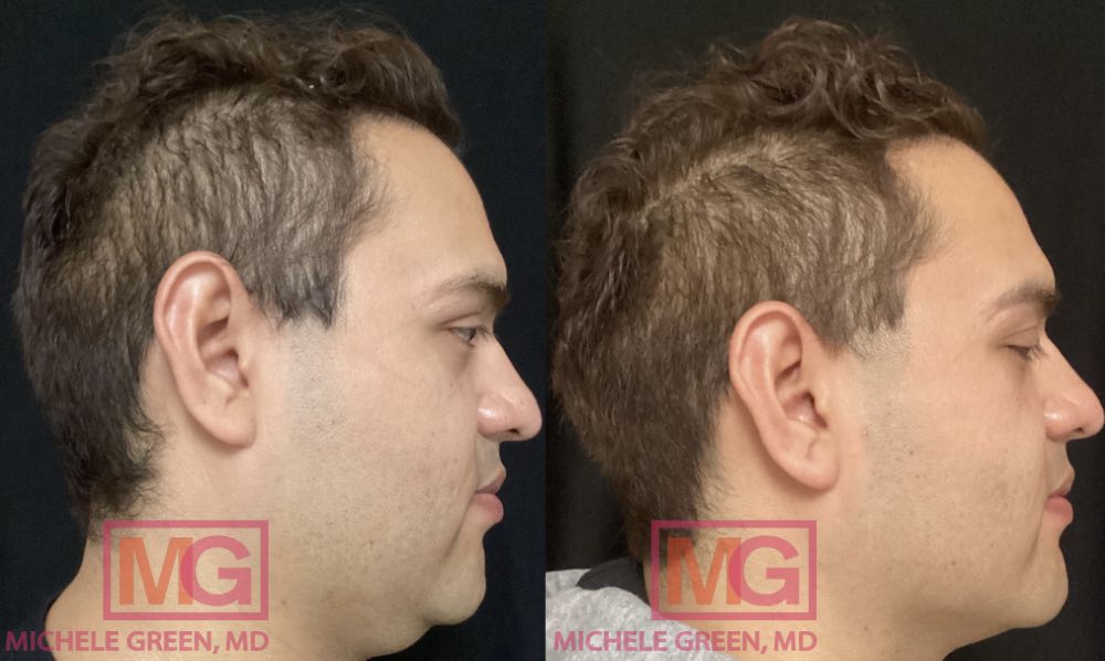 AM 31 yo male before and after Kybella Photos 1 month apart MGWatermark