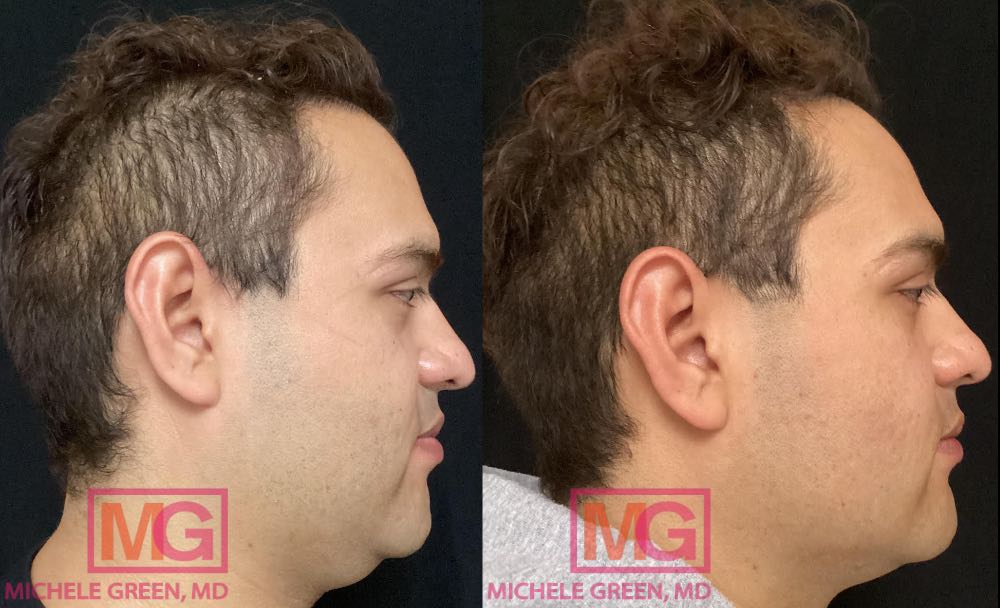 AM 31 yo male before and after Kybella Photos 2 month apart MGWatermark