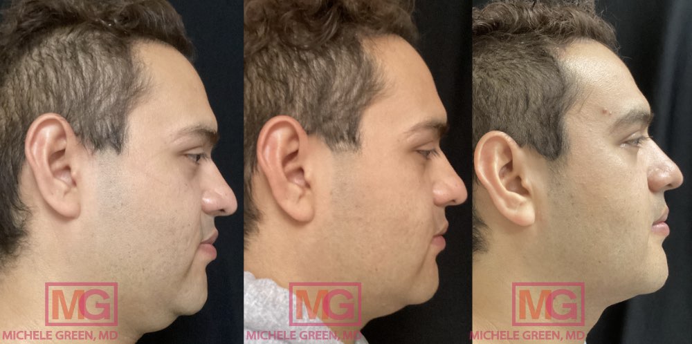 31 year old male treated with Kybella - 3 sessions before and after