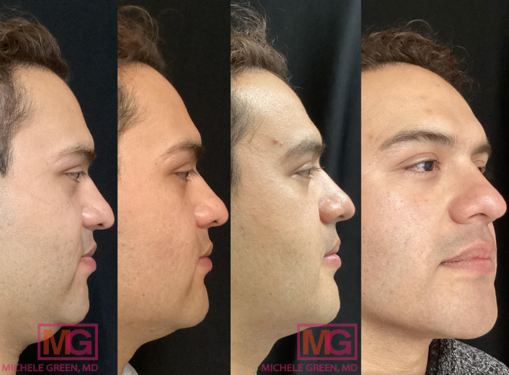 AM 6 months before and after 4 Kybella MGWatermark