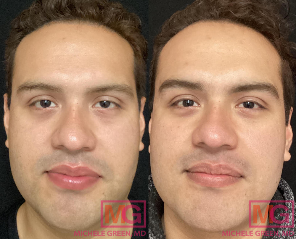 31 year old male treated with Kybella - 3 sessions before and after
