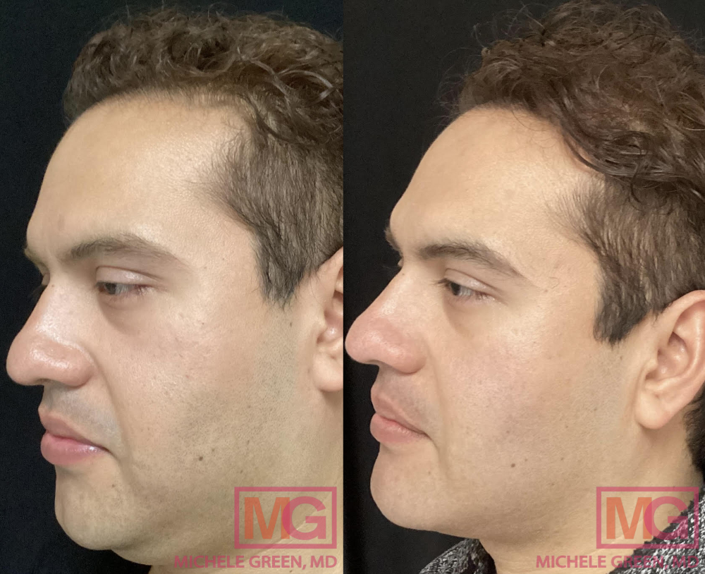 31 year old male treated with Kybella - 4 sessions before and after