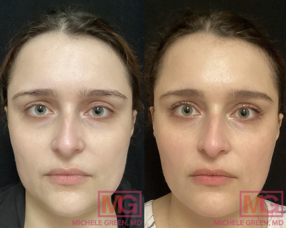 30 y/o female before and after one Botox masseter treatment 