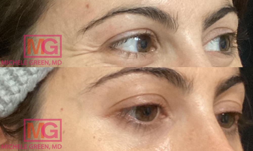 AS 35 yo female before and after Botox eyes 2 months apart EYES ONLY MGWatermark