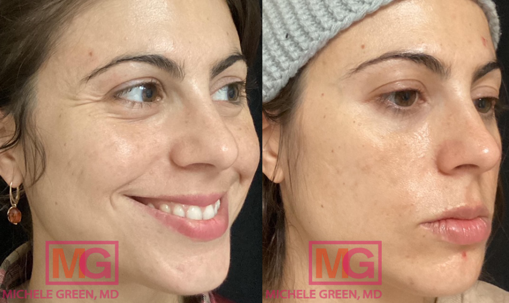 AS 35 yo female before and after Botox eyes 2 months apart MGWatermark