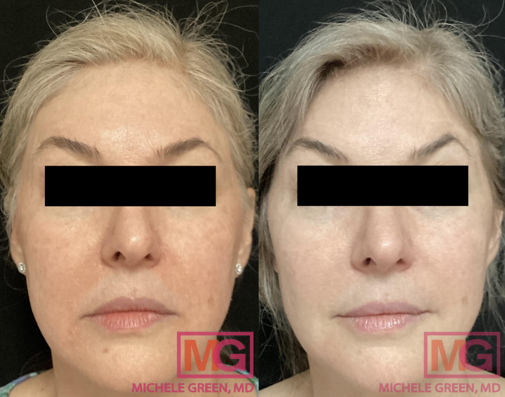 Restylane and Botox for eyes and glabella, plus Juvederm Voluma and Ultra Plus