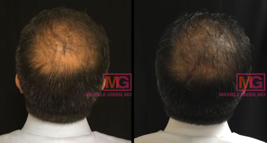 Male PRP hair 6 months since first PRP treatment.