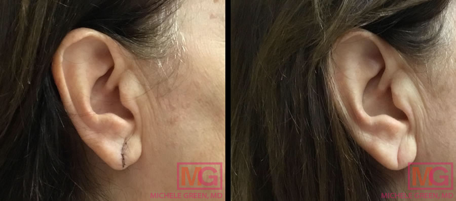 Split' earlobe repair