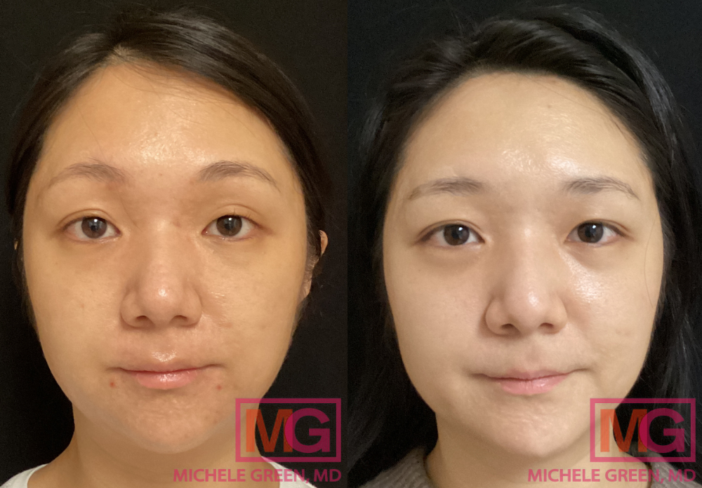 Before and after acne treatments