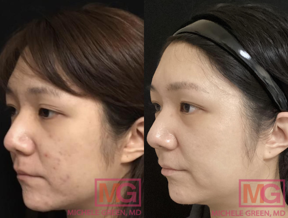 AZ 29yo female before and after acne and acne scar treatments 1 year apart ANGLE LEFT MGWatermark