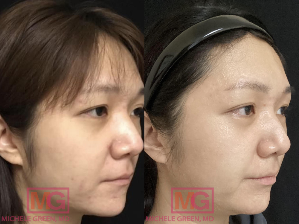 29 year old female, before and after acne treatment – 1 year