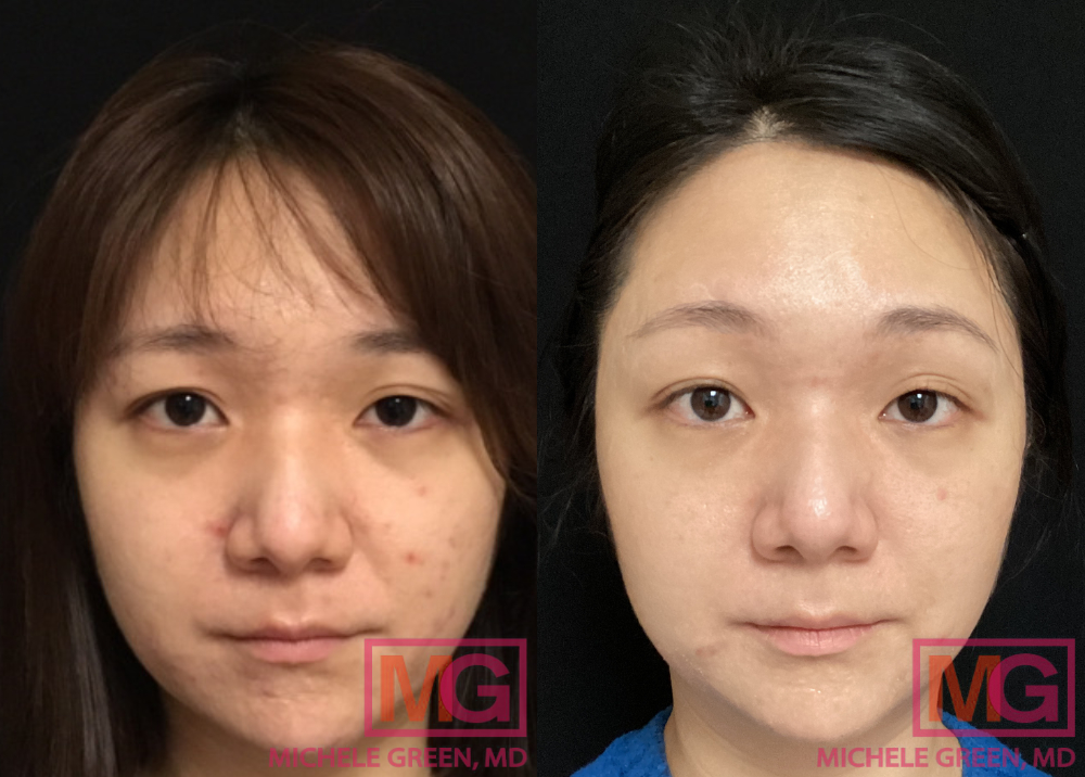 30 year old female Before and After Accutane, eMatrix & Sculptra