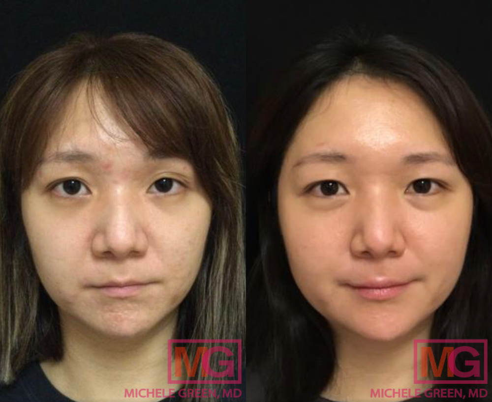 Acne Before After Feb 2022 MGWatermark