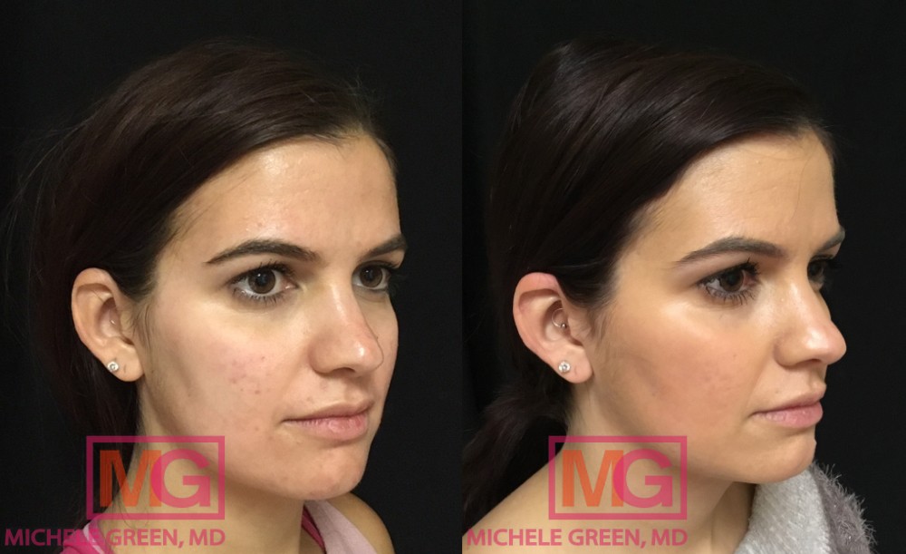 B.S 30 1 Month Before and After Accutane ANGLEL MGWatermark 1