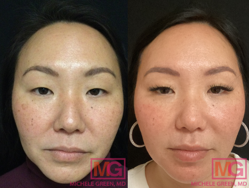 BM 42 year old before and after fillers juvederm lips and nasolabial MGWatermark