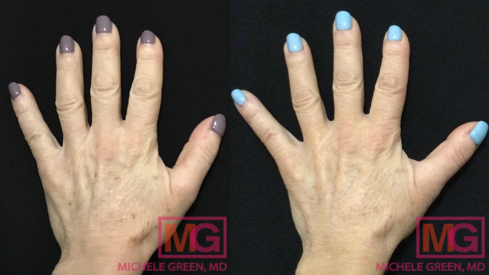 BM 61 yo female 2 and a half weeks before after age spot treatment Alex Trivantage laser MGWatermark 1